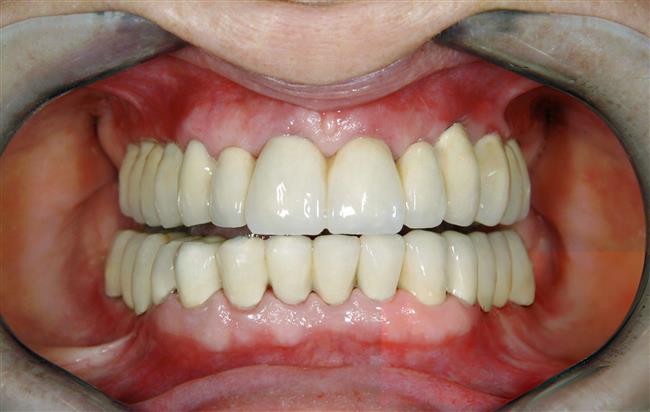 عدم تحریک استخوان فک