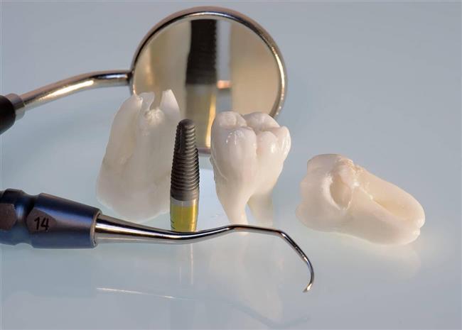 ملاحظات بعد از کاشت ایمپلنت دندان