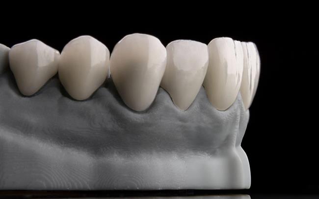 بریج‌های دندانی با ایمپلنت