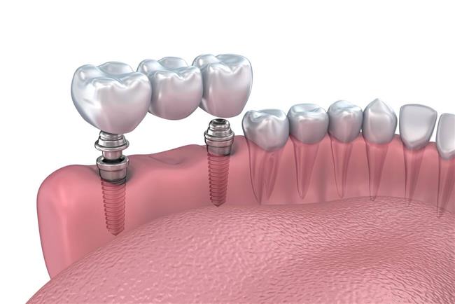اتصال اباتمنت در کاشت ایمپلنت دندان