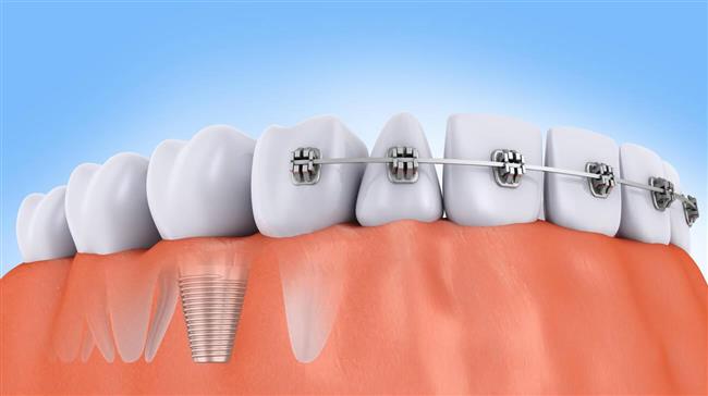 ایمپلنت دندان