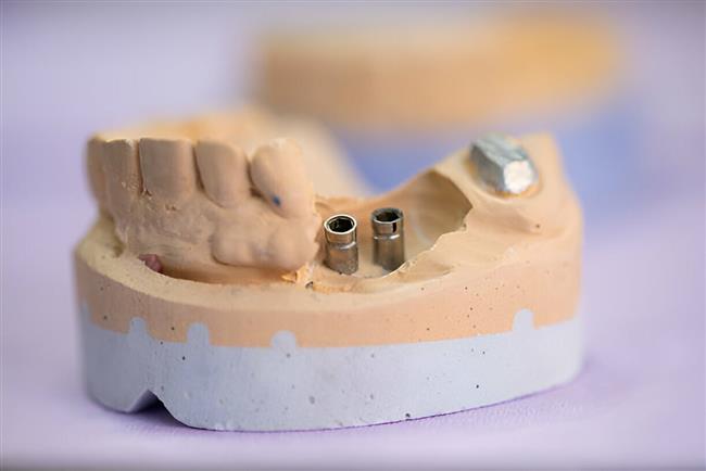 شرایط منع مصرف بریج دندان