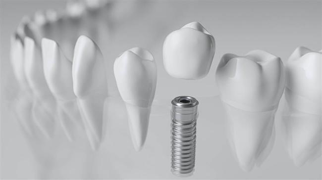 مراحل و مزایای ایمپلنت دندان