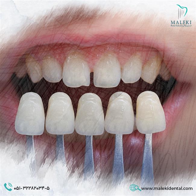 انواع لمینت دندان