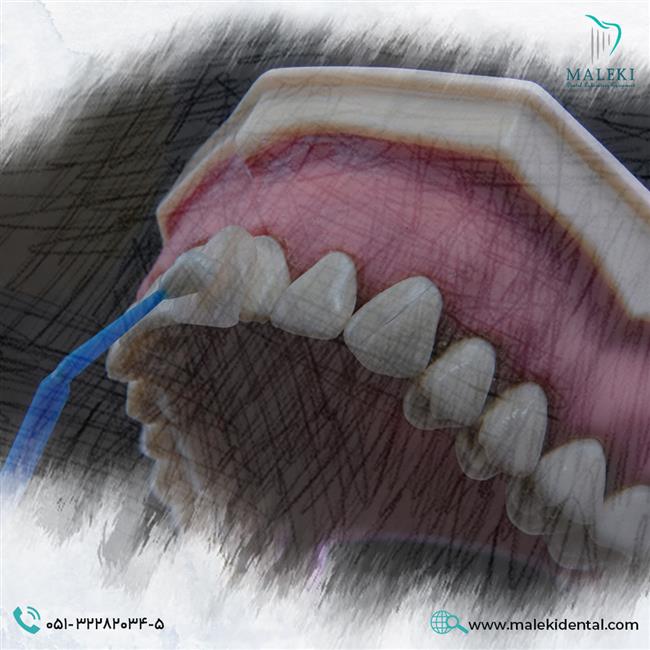 لمینت دندان