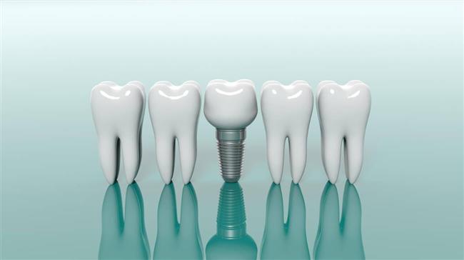 آشنایی جامع با مراحل و مزایای ایمپلنت دندان