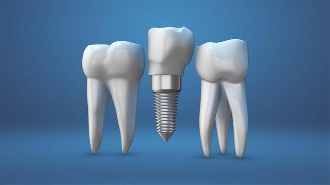  فرآیند ایمپلنت دندان