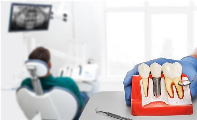 کاشت ایمپلنت دندان