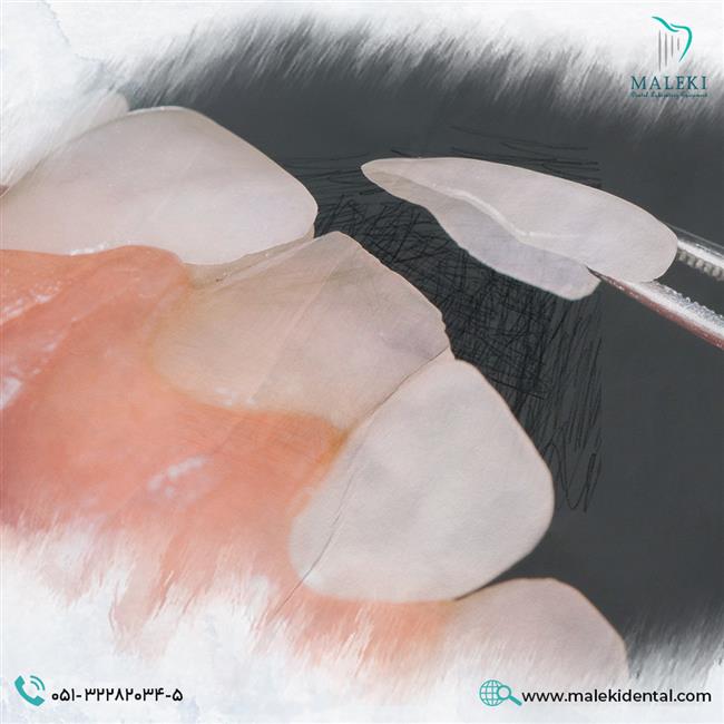 مزایای لمینت دندان